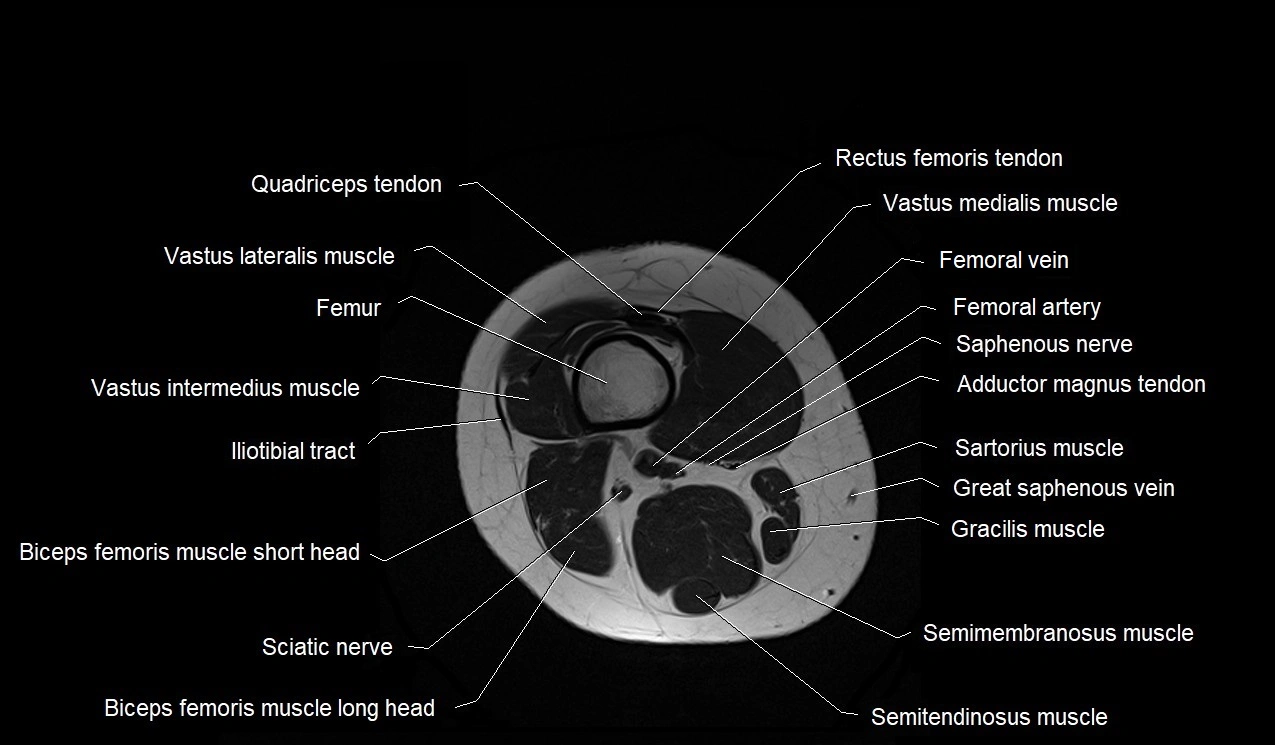 MRI thigh cross sectional anatomy image 47.webp